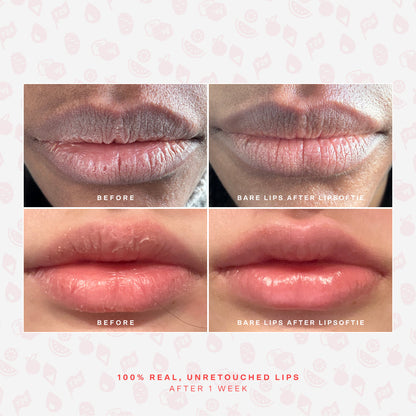 LipSoftie® Lip Treatment Set